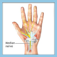 karpaltunnelsyndrom