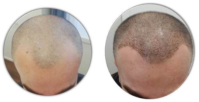 Haartransplantation Schweiz, Haartransplantation Zürich, HaarTX